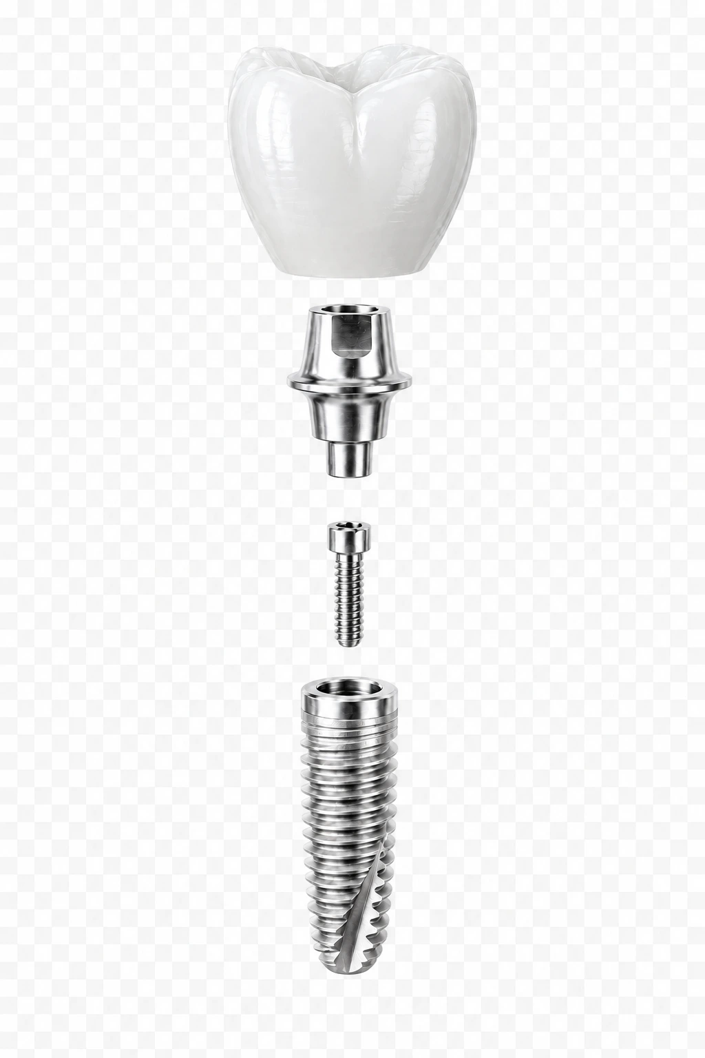 Realistic conceptual illustration of the four components of a dental implant